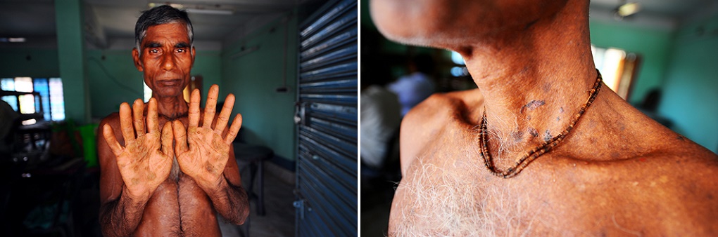 <p>Jagadish Das, 52, a smallholder farmer of Mahishdanga village in Nadia district is a regular patient at Kolkata’s School of Tropical Medicine. Doctors there have said the lesions on his hands and throat are effects of excessive arsenic in drinking water. His skin peels and bleeds frequently [image by Dilip Banerjee]</p>