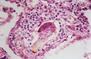 <p>Schistosoma ovum in the lung parenchyma surrounded by a chronic inflammatory cellular infiltrate. Granulomatous reactions may also be seen [image by: Philip Kane / Flickr]</p>