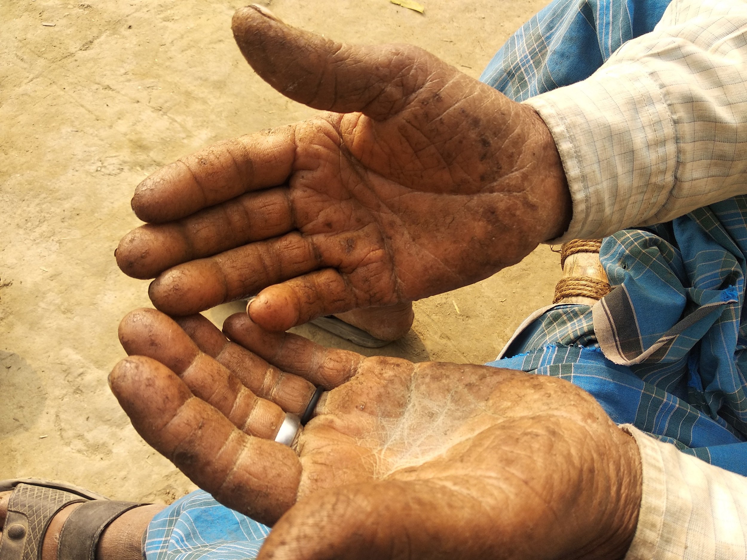 hands with lesions from arsenic-laced water poisoning