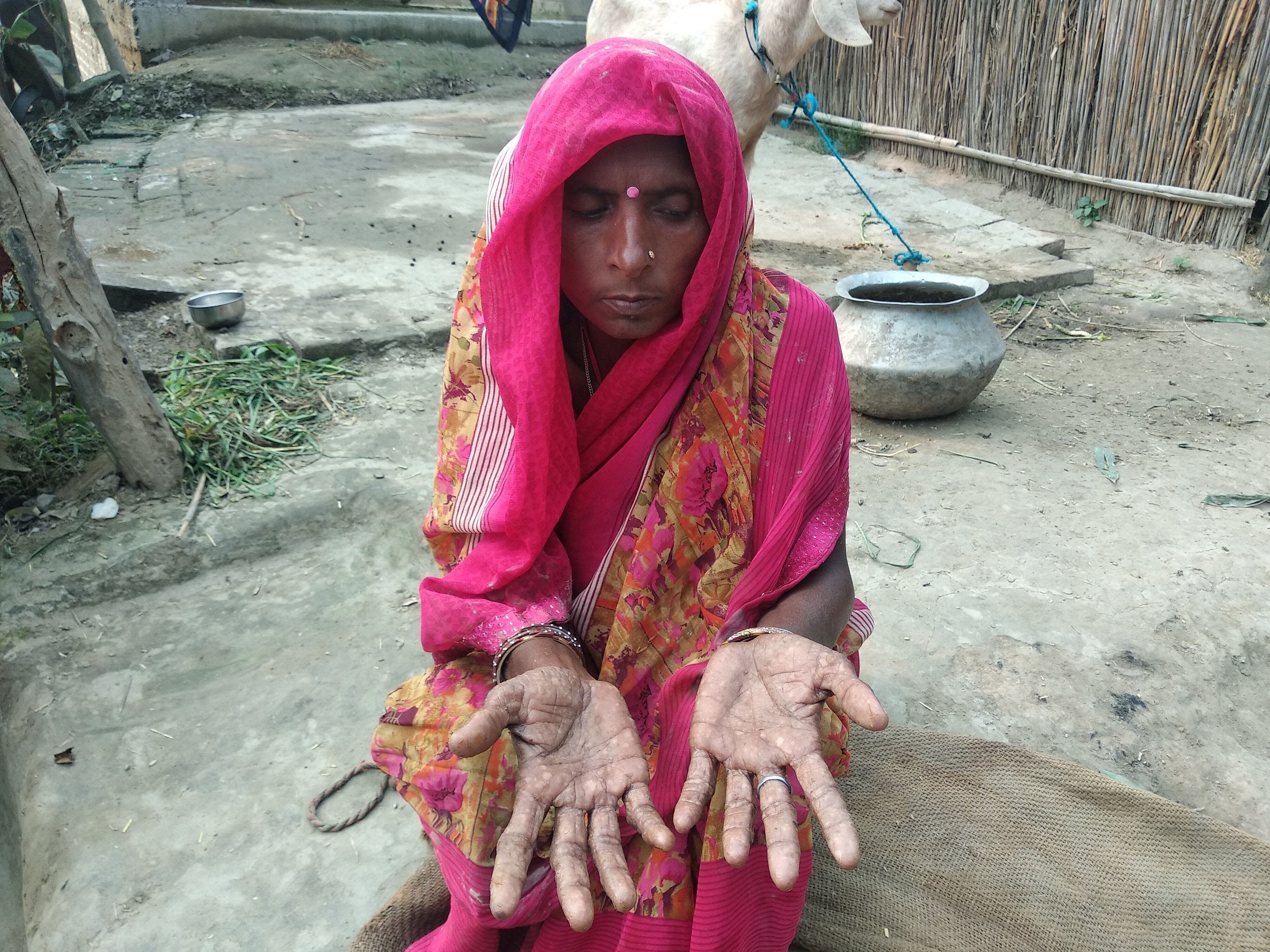 Indu Devi, 35, of Chapar village of Moinuddinagar block in Samastipur district of Bihar. She is suffering from lesions on her hands and feet but she never bothered to find out how they appeared. She said these don't itch, so she didn't think they need to be treated [image by: Umesh Kumar Ray]